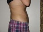 1 week after smart lipo - side